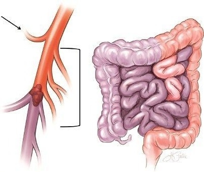 Acute Mesenteric Ischemia Treatment in Electronic City